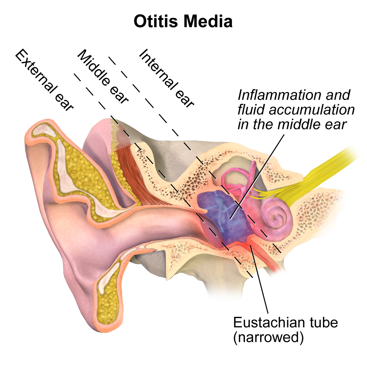 otitis-media